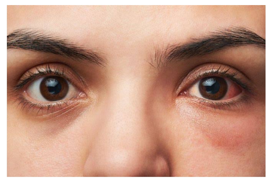 Conquering Conjunctivitis: Simple Steps to Prevent Pink Eye at Home